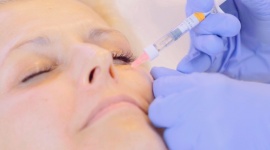 Wypełniacze, czyli jak bezpieczne przywrócić młody wygląd Uroda, LIFESTYLE - . O tym dlaczego to właśnie zabiegi z wykorzystaniem kwasu hialuronowego są obecnie jednymi z najpopularniejszych opowiada dr n. med. Krzysztof Jakubowski, certyfikowany lekarz medycyny estetycznej, kierownik medyczny Kliniki ESTELL.