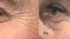 Uroda, LIFESTYLE - Kolejne badania potwierdziły, że Sunekos® to preparat skuteczny i bezpieczny. Tym razem obserwacje zostały przeprowadzone w Polsce. Włoski sposób na odmładzanie Polek – Sunekos® Uroda, LIFESTYLE - Kolejne badania potwierdziły, że Sunekos® to preparat skuteczny i bezpieczny. Tym razem obserwacje zostały przeprowadzone w Polsce.