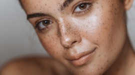 Uroda, LIFESTYLE - Nasza skóra zmienia się przez całe życie. I niestety nie zawsze są to zmiany na lepsze. Zmiany pigmentacyjne i przebarwienia to bardzo częste „pamiątki” przywożone z wakacji. Zauważyłaś u siebie nieestetyczne brązowe plamki? Być może jest to melasma. BRĄZOWE PLAMKI NA SKÓRZE? Uroda, LIFESTYLE - Nasza skóra zmienia się przez całe życie. I niestety nie zawsze są to zmiany na lepsze. Zmiany pigmentacyjne i przebarwienia to bardzo częste „pamiątki” przywożone z wakacji. Zauważyłaś u siebie nieestetyczne brązowe plamki? Być może jest to melasma.