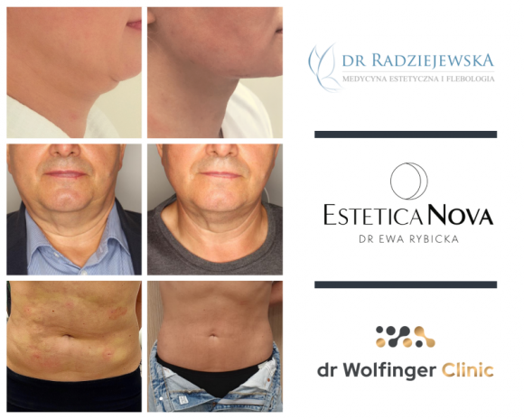 Lifting nieinwazyjny Endolift – co na jego temat mówią lekarze? Uroda, LIFESTYLE - Jak uzyskać́ efekt liftingu i wyszczuplenia bez konieczności użycia skalpela, przygotowywania pacjenta do zabiegu, czasu rekonwalescencji i bez potrzeby wykonywania serii zabiegów? title =